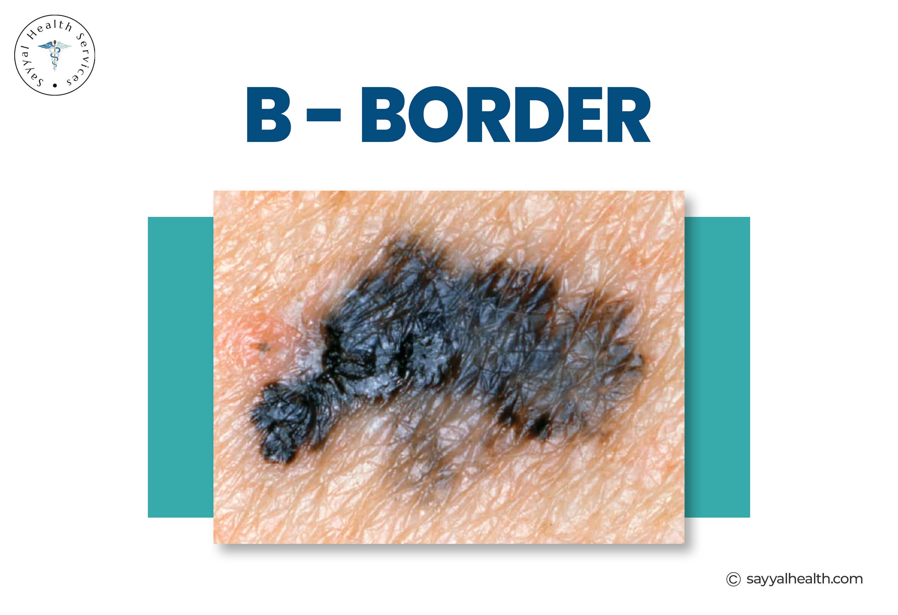 Melanoma border irregularity - jagged edges on dark lesion